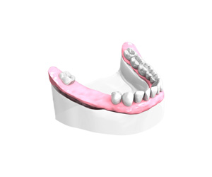 Bridge sur implants dentaires Paris 15