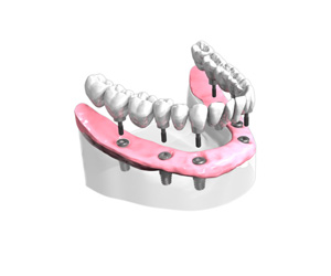 Bridge complet sur implants dentaires Paris 15