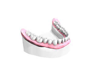 Bridge sur implants dentaires Paris 15
